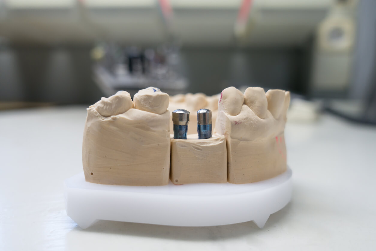 dental implants